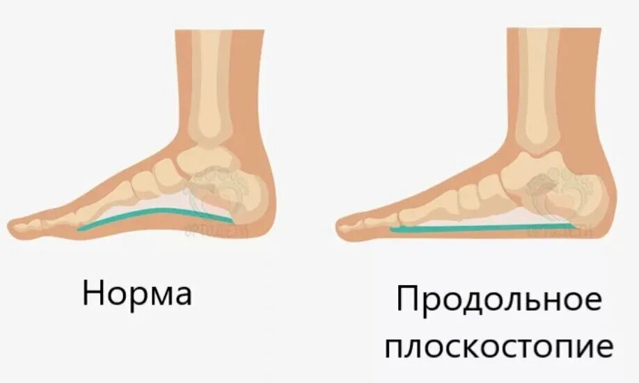 Стопа с 1 степенью плоскостопия. Плоскостопие 2 степени что это. 2 степень плоскостопия стопа. Продольно-поперечное плоскостопие 3 степени. Продольное плоскостопие степени.
