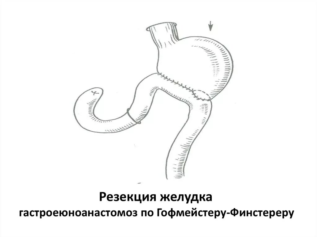 Резекция желудка анемия. Операция Бильрот 2 в модификации гофмейстера Финстерера. Резекция желудка Бильрот 2 в модификации гофмейстера-Финстерера. Гофмейстеру Финстереру резекция.