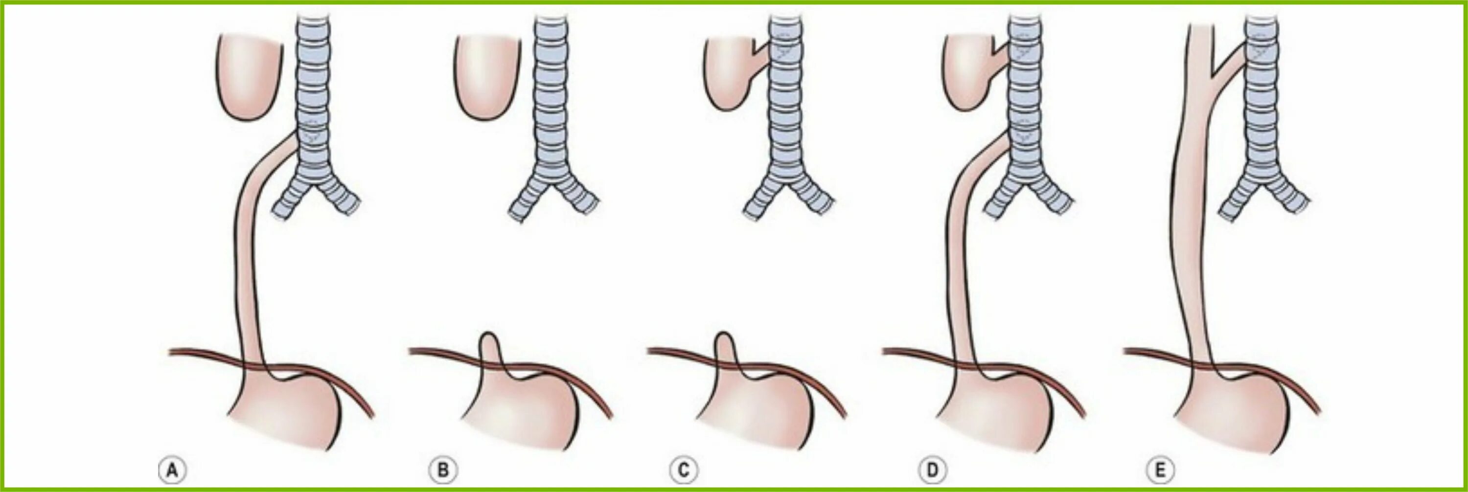 Трахеопищеводный свищ. Врожденный пищеводно-трахеальный свищ это. Врожденный трахеопищеводный свищ. Атрезия пищевода классификация. Слепой пищевод