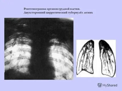 Кавернозно цирротический туберкулез