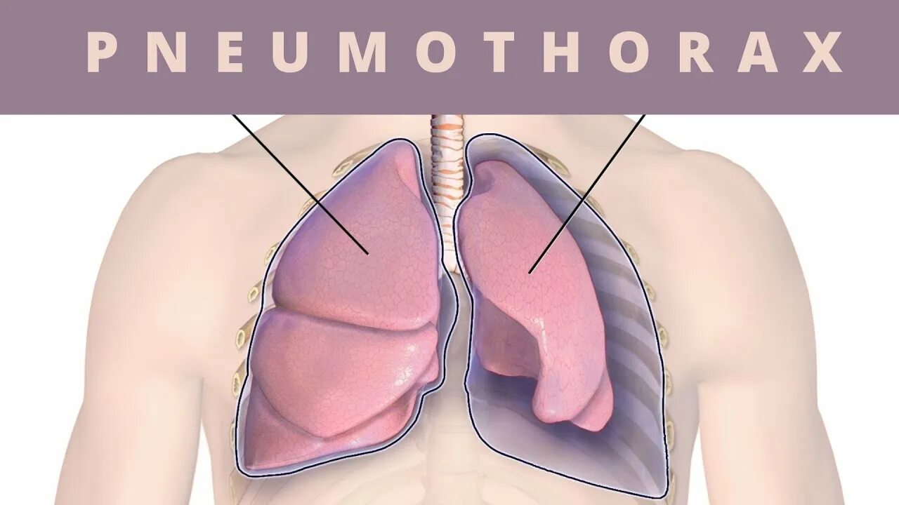 Катамениальный пневмоторакс. Пневмоторакс это коллапс легкого. Местоположение легких