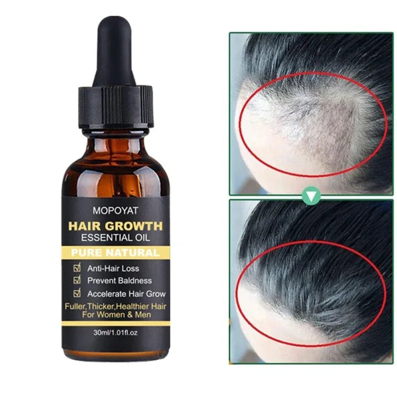 Hair growth Essence Oil. Для роста волос. Средство для роста волос. Маски для выпадения для роста волос. Восстановление густоты волос отзывы