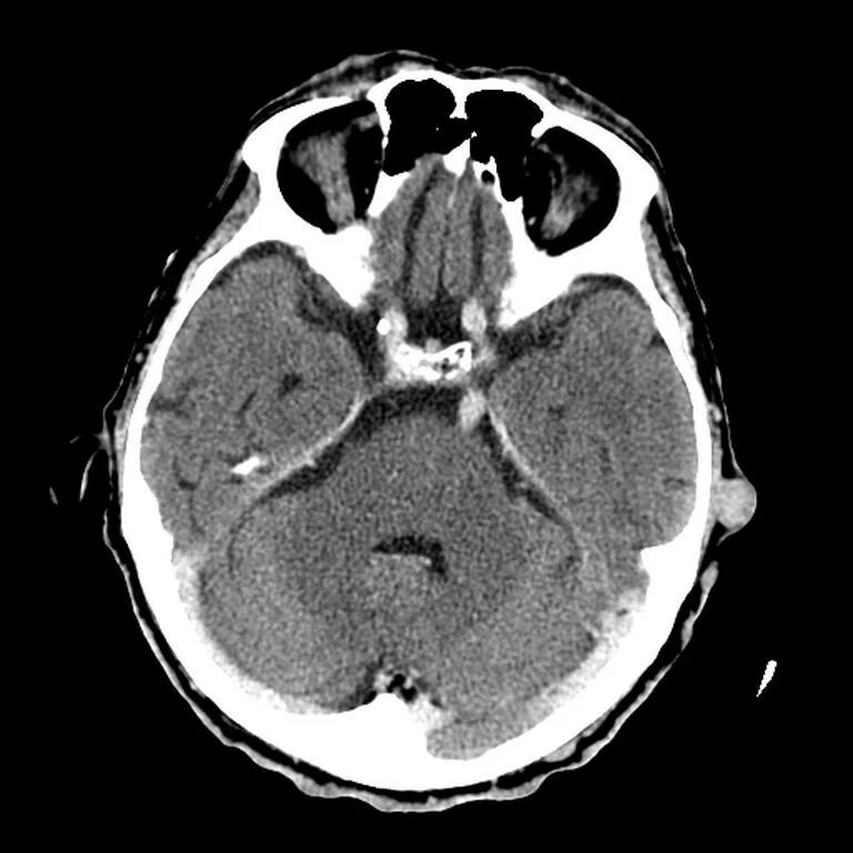 Мозга нижний тагил. АВМ головы кт. Aspect кт головного. Кт головы плоскости. Диск для кт головного мозга.