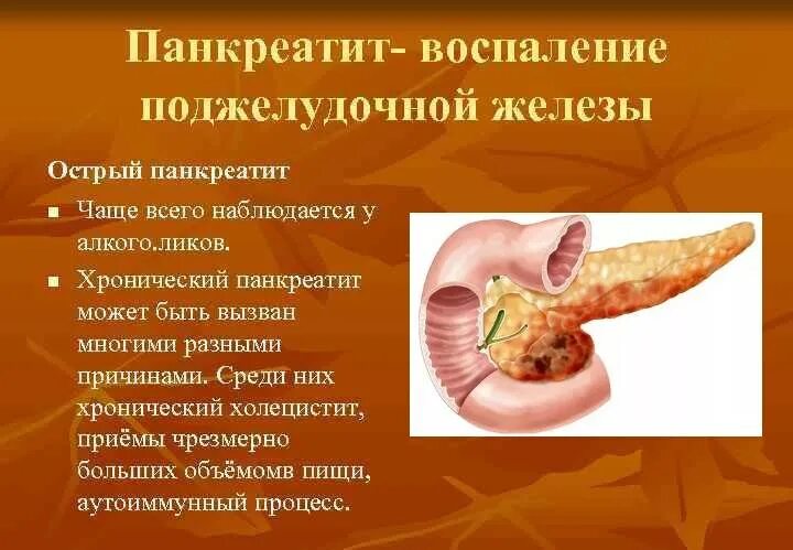 Почему воспаляется поджелудочная. Воспаление поджелудочной железы. воспалённая поджелудочная железа. поджелудочная железа воспп. панкреатит поджелудочной железы.