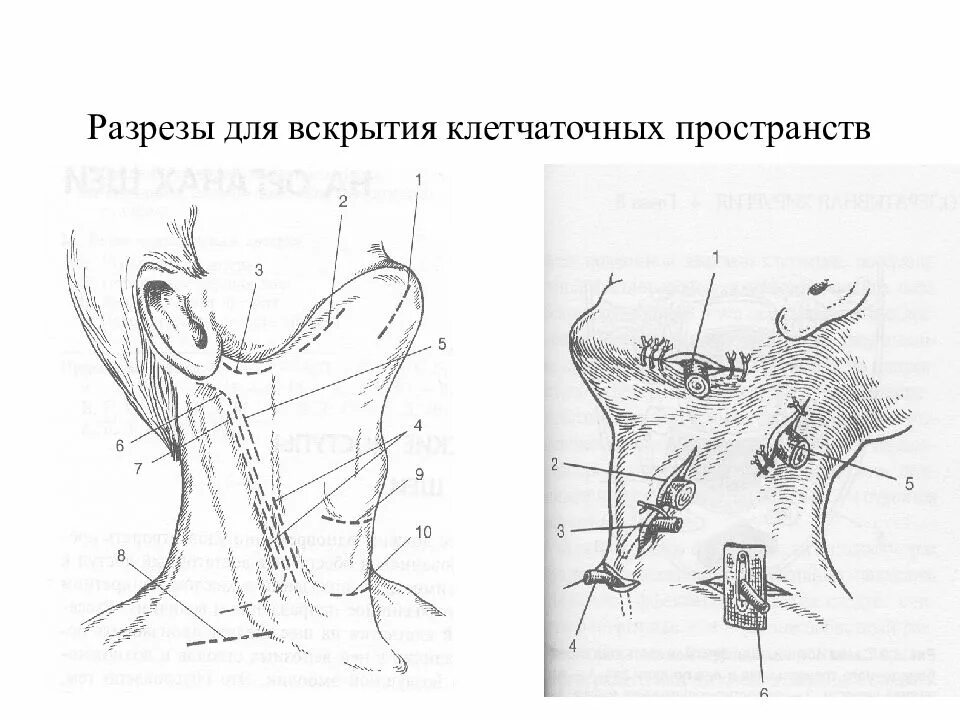 Операция абсцесс шеи. Разрезы клетчаточных пространств при флегмонах. Разрезы для вскрытия флегмон шеи. Разрезы шеи Оперативная хирургия. Флегмоны шеи топографическая анатомия.