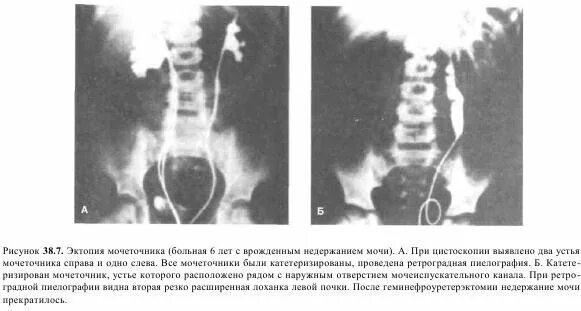 Два мочеточника. Эктопия устья мочеточника рентген. Эктопия устья мочеточника экскреторная урография.