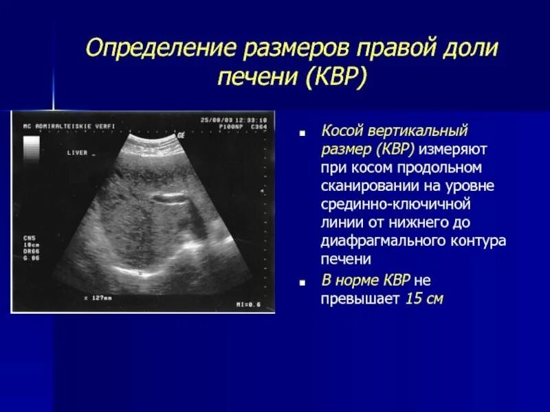 Квр печени увеличена. УЗИ печени нормальные показатели таблица. Толщина левой доли печени в норме на УЗИ. Нормы размеров печени печень на УЗИ.