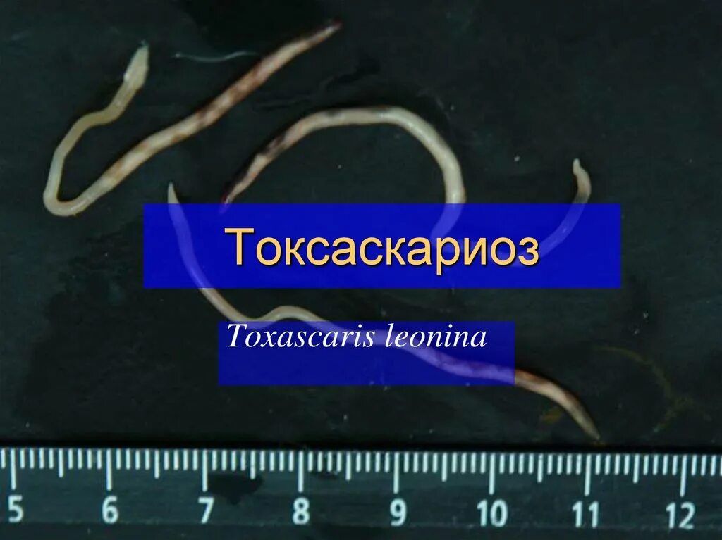 Токсокары у детей симптомы