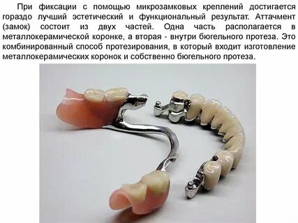Бюгельный протез дипломная работа