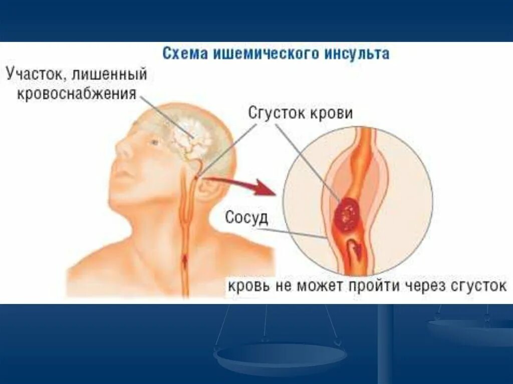 Ишемический инсульт нельзя. Осложнения ишемического инсульта. Ишемический инсульт последствия. Ишемич инсульт осложнения.