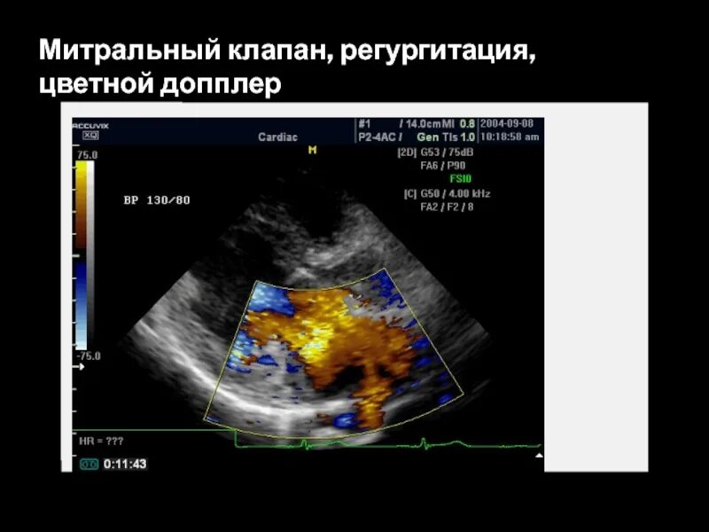 Аортальная недостаточность допплер эхокг. Регургитация 3 клапанов. Митральная регургитация эхокг. Регургитация 3 клапанов. Митральная регургитация ii степени.