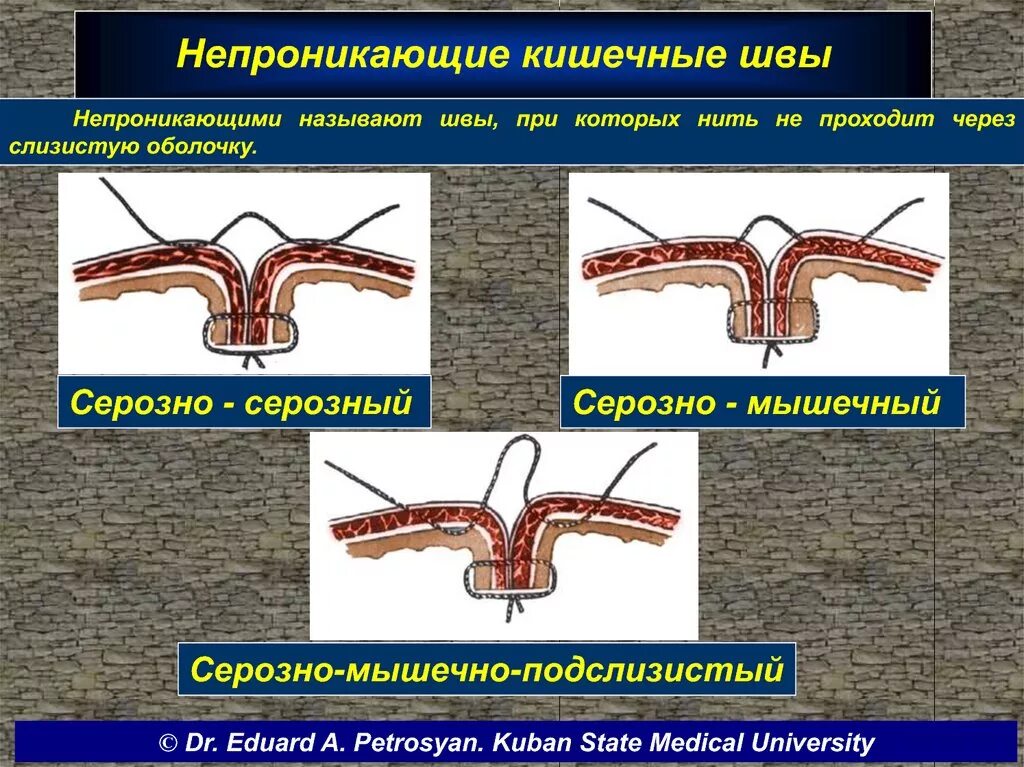 Виды кишечных. Кишечный шов серозно-серозные. непроникающие кишечные швы. кишечные непроникающие серозные швы. классификация кишечных швов.