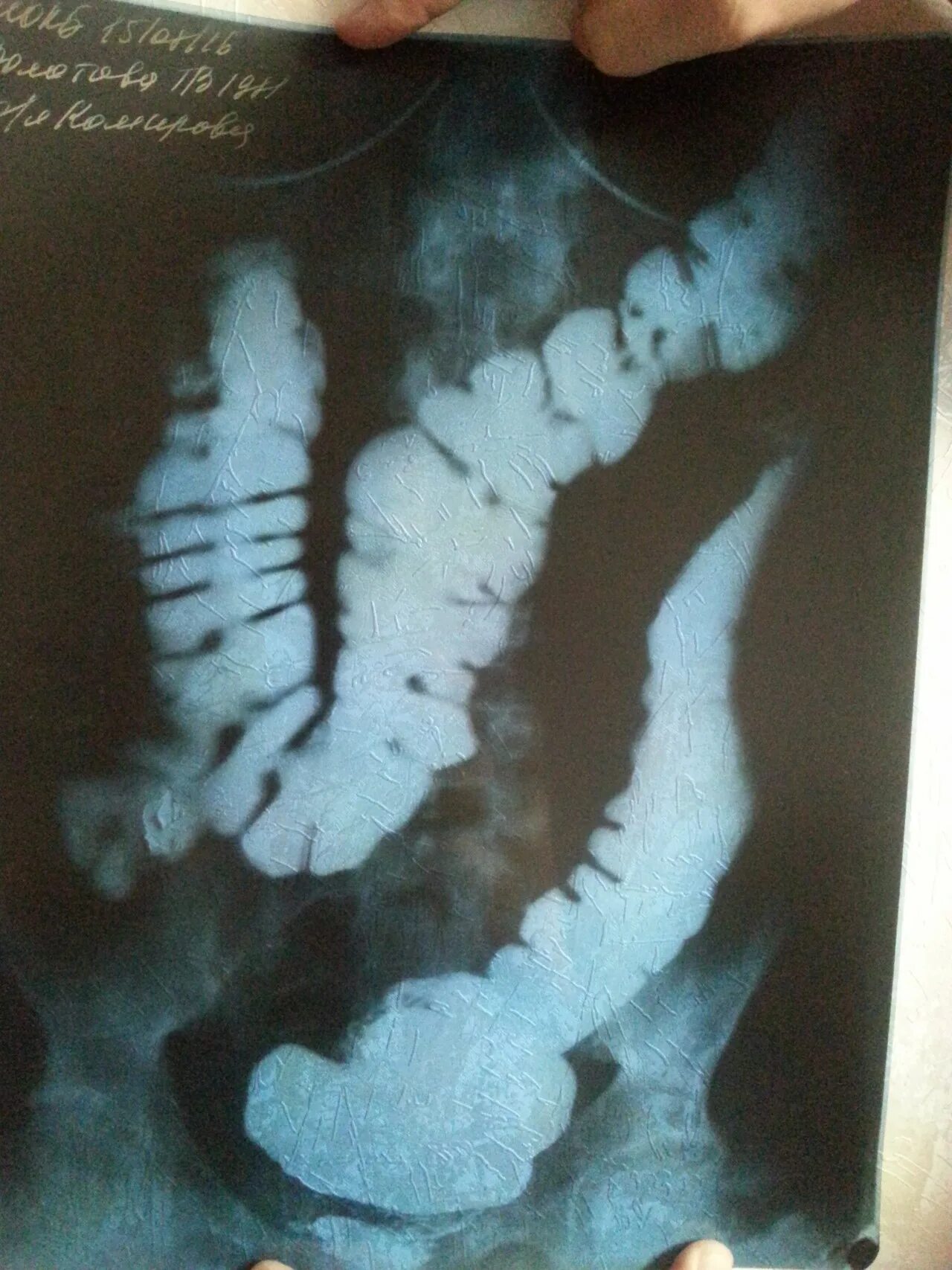 Лекарства от спаечной болезни брюшной полости. Спаечная болезнь брюшины. Как болят спайки кишечника симптомы. Спаечная кишечная непроходимость. Профилактика спаечного процесса.
