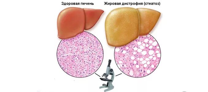 Токсическая дистрофия печени. Гигроскопическая дистрофия печени. Алкогольный гепатит печени жировая дистрофия. Паренхиматозная жировая дистрофия печени. Алкогольный цирроз печени жировая дистрофия.