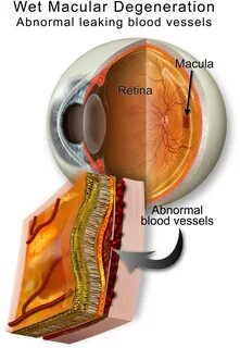 Age related macular degeneration