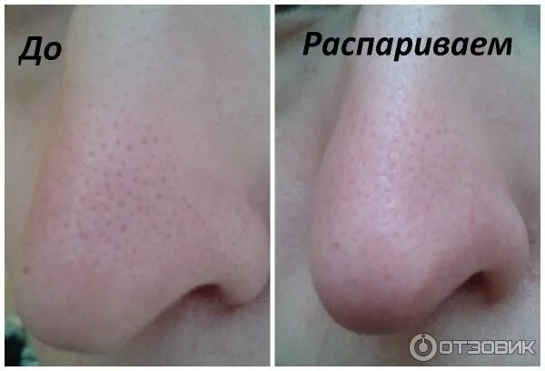 Как распарить кожу лица перед чисткой