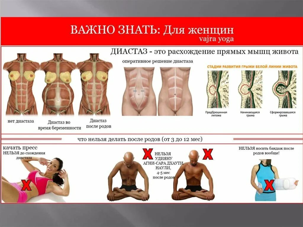 Почему напрягается живот. Расхождение мышц живота. диастаз прямой мышцы живота. расхождение прямых мышц живота. расхождение прямой мышцы живота.