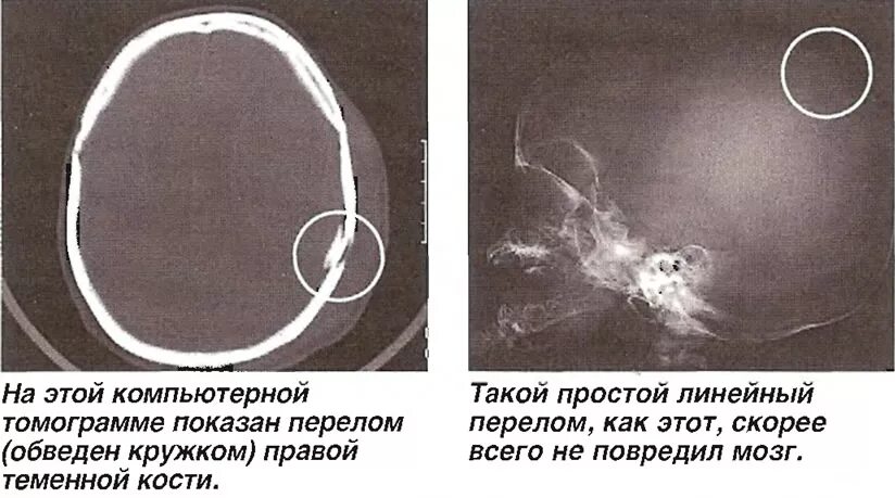 линейный перелом теменной кости. импрессионный перелом теменной кости кт. перелом затылочной кости черепа рентген. неполный перелом теменной кости. оскольчатый перелом черепа рентген.