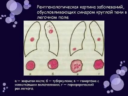 Синдром поле