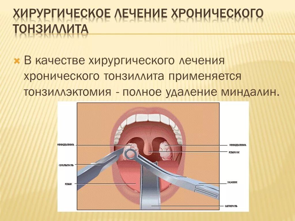 Тонзиллит лечение домашними средствами. Паратонзиллярный абсцесс миндалины. Миндалины глоточного кольца строение и функции в организме. Небные миндалины хронический тонзиллит. Хронический тонзиллит вид гланд.