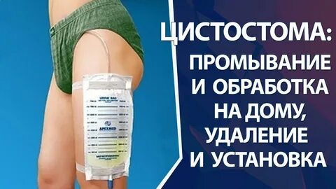 Цистома мочевого пузыря