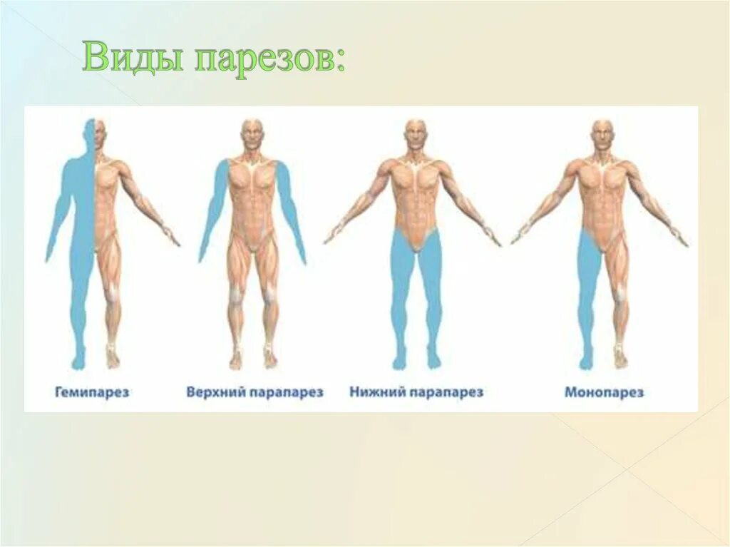 Вид вплоть. Гемипарез и гемиплегия синдромы. виды порезов и пораличей. виды параличей.