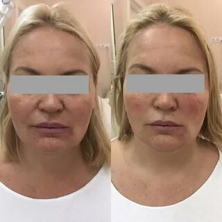 Филлеры на основе