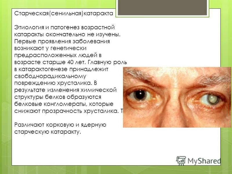 Причины заболевания катаракты