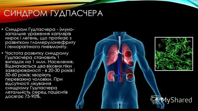 Синдром гудпасчера это. Синдром гудпасчера презентация. синдром гудпасчера этиология. синдром гудпасчера патогенез.