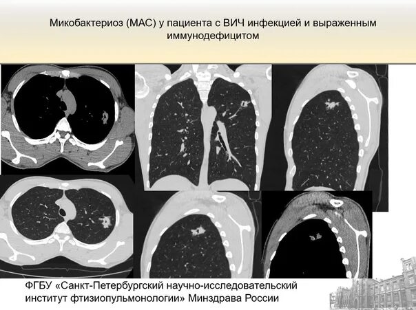 Нетуберкулезный микобактериоз. Атипичный микобактериоз кт. Диссеминированный микобактериоз легких. Нетуберкулезный микобактериоз легких кт. Микобактериальная пневмония на кт.