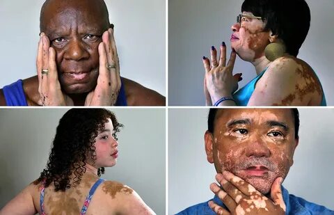 Improved treatments for vitiligo may come soon, but do patients want them? 
