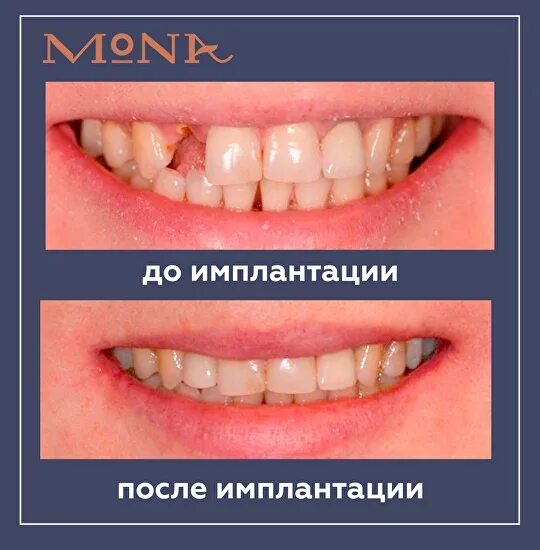 Через сколько можно вставить зубы. Имплантация зубов до и после. Зубы до и после имплантации. Имплантация зубов LJ B gjckt. Импланты зубов до и после.