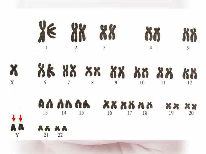Изменение числа отдельных хромосом. Полиплоидия кариотип. Моносомик набор хромосом. Моносомики и трисомики. Трисомик набор хромосом.