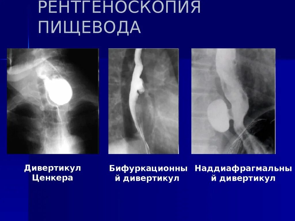 Дивертикул Ценкера пищевода. Стриктура пищевода рентген. Ценкеровский дивертикул пищевода на рентгене. Контрастная рентгеноскопия пищевода и желудка. Скопия пищевода желудка