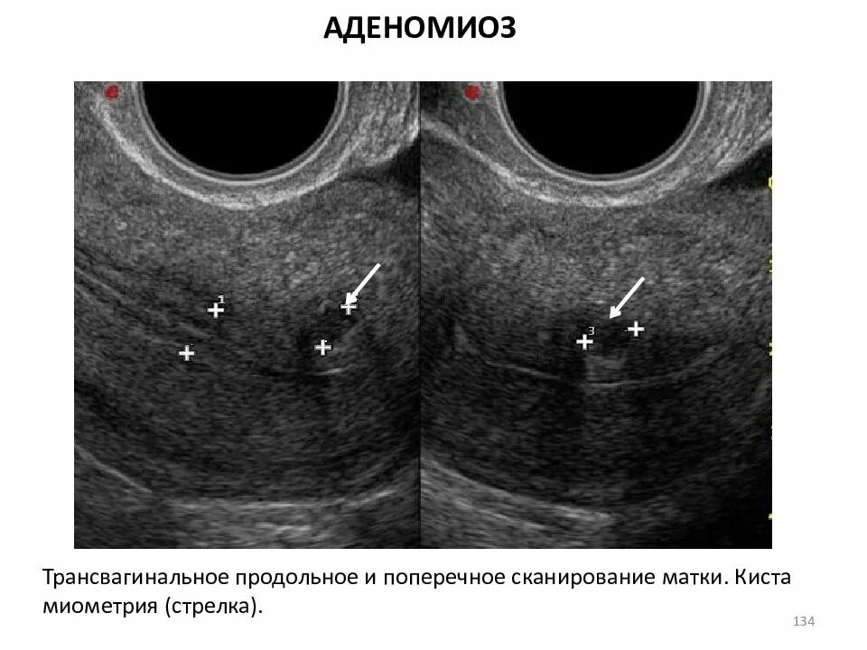 Узловая форма аденомиоза матки на УЗИ. Киста эндометрия матки. Узловой аденомиоз матки. Эхопризнаки аденомиоза что это