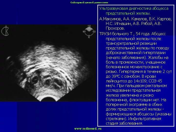 Дгпж узи. Трузи предстательной железы норма. УЗИ простаты заключение норма. УЗИ предстательной железы Изранов.