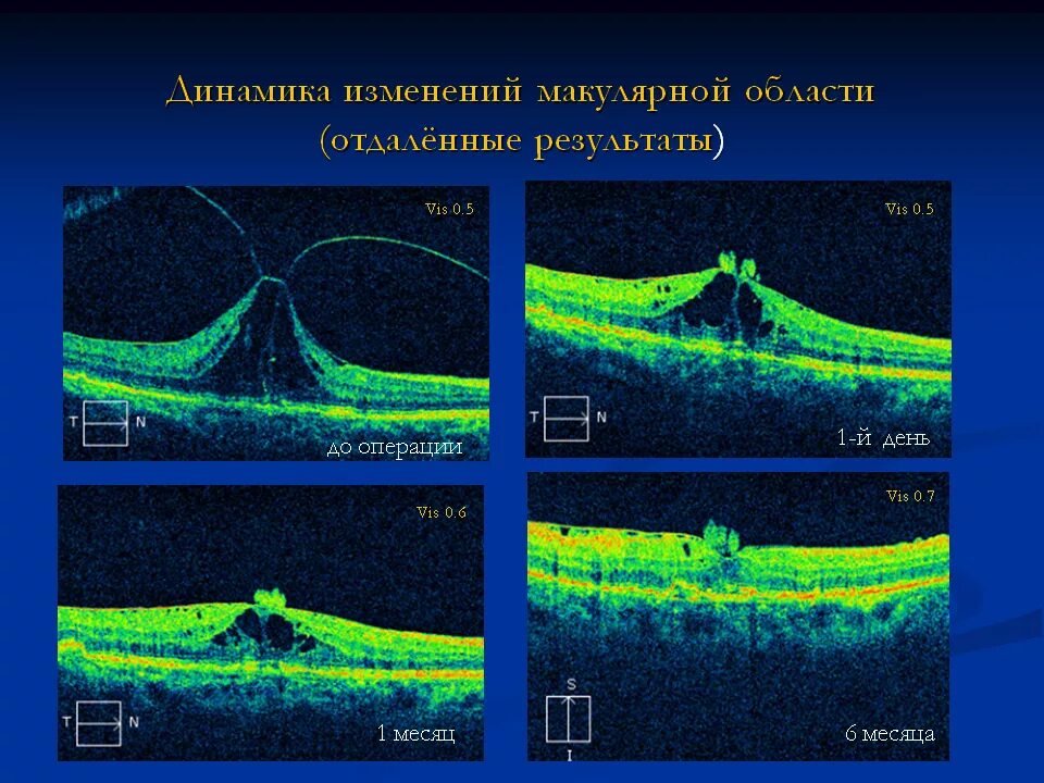 Витреомакулярный тракционный синдром глаза. Макулярный тракционный синдром. Макулярный разрыв сетчатки ОСТ. Ламеллярный макулярный разрыв сетчатки. Макулярный разрыв после операции