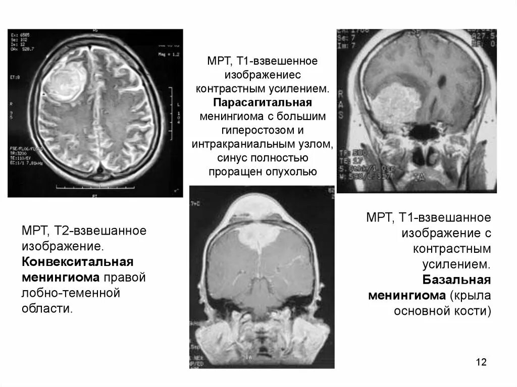 Образование в лобной доле. Менингиома лобно-теменной области. Мрт.. Опухоли мозга (менингиома);. Менингиома лобной доли кт. Менингиома лобной области мрт.