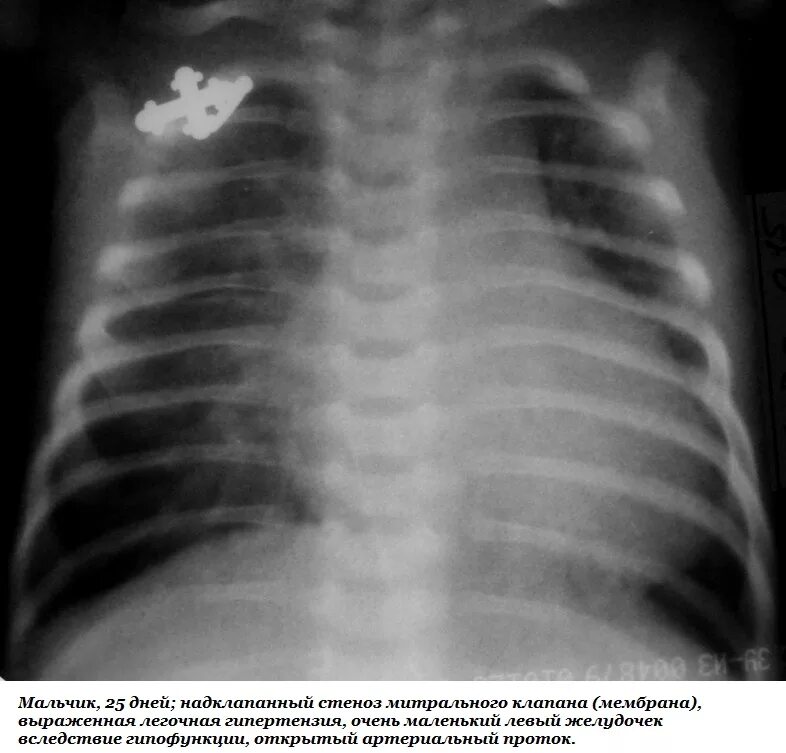 Снимок при бронхите у ребенка. Рентгенография острого бронхита. Снимок грудной клетки при бронхите. Рентген грудной клетки при бронхите.