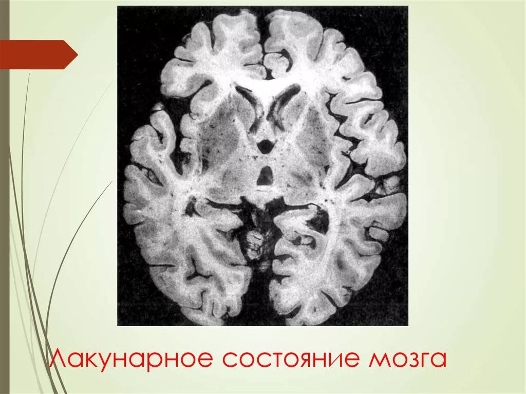 Инсульт в бассейне правой средней мозговой артерии. Бассейн правой сма. Ишемический онмк мрт. Ишемический инсульт мозга на кт. Лакунарное состояние мозга.