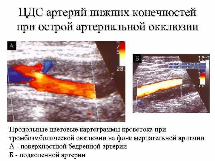 Дуплексное сканирование вен нижних конечностей что это. УЗИ допплерография артерий нижних конечностей. Окклюзия подколенной артерии на УЗИ. Допплеровское сканирование сосудов нижних конечностей. Атеросклероз артерий нижних конечностей на УЗИ.