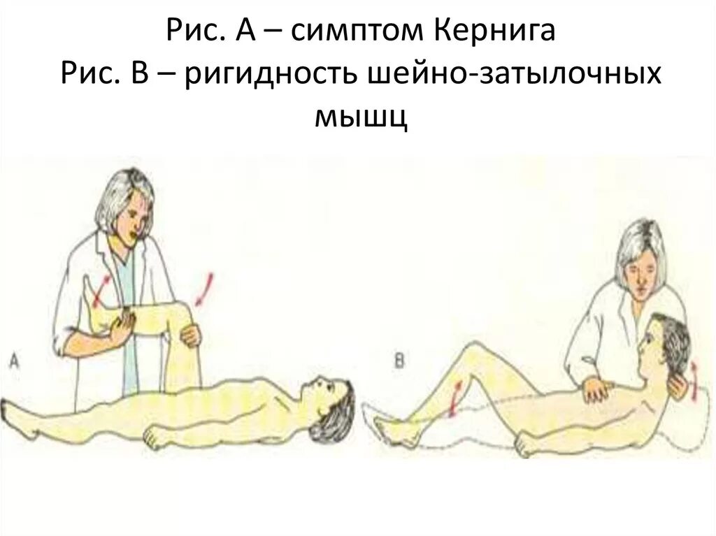 Ригидность мышц затылка симптом кернига. Менингеальные симптомы ригидность затылочных мышц. менингит симптомы кернига. симптом кернига и ригидность затылочных мышц. симптом кернига и брудзинского.