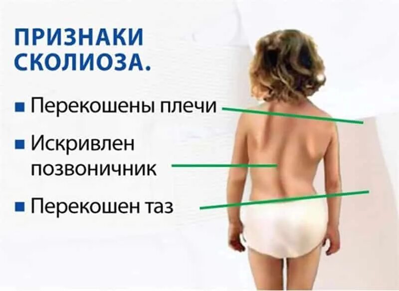 Сколиоз позвоночника у детей 2 степени. У ребенка сколиоз что делать. Дети с заболеваниями сколиоза. У ребенка сколиоз что делать. У ребенка сколиоз что делать.