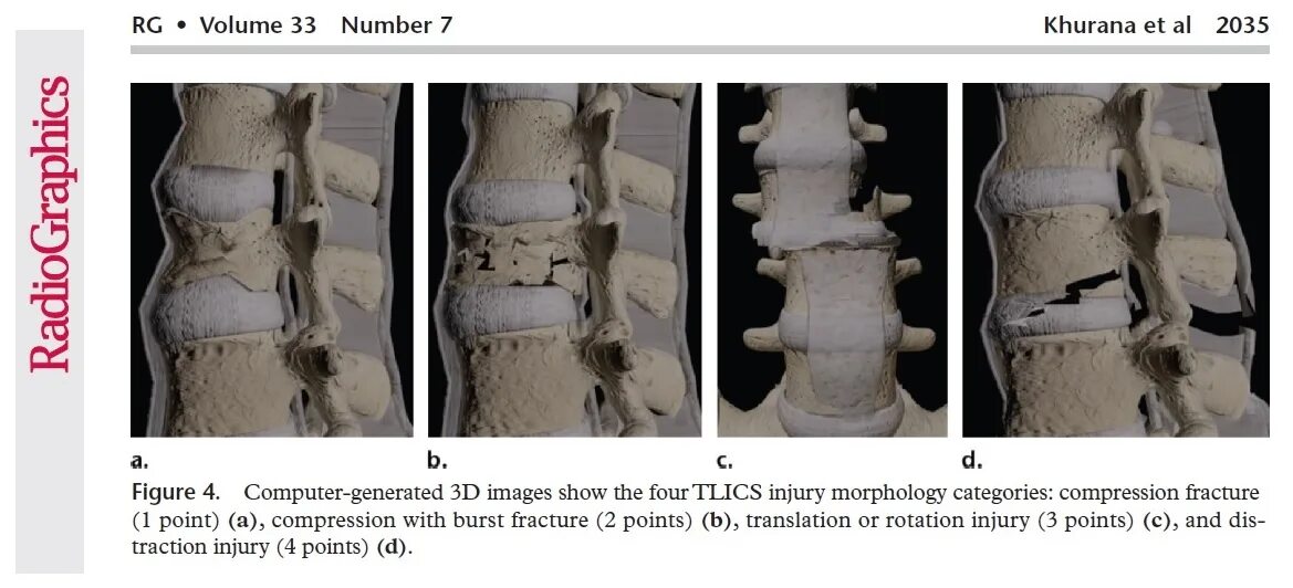 Лечение последствия компрессионного перелома позвоночника. Компрессионный перелом с4 с5. Компрессионный перелом позвоночника л1. Компрессионный перелом th11. Компрессионный перелом л 1.