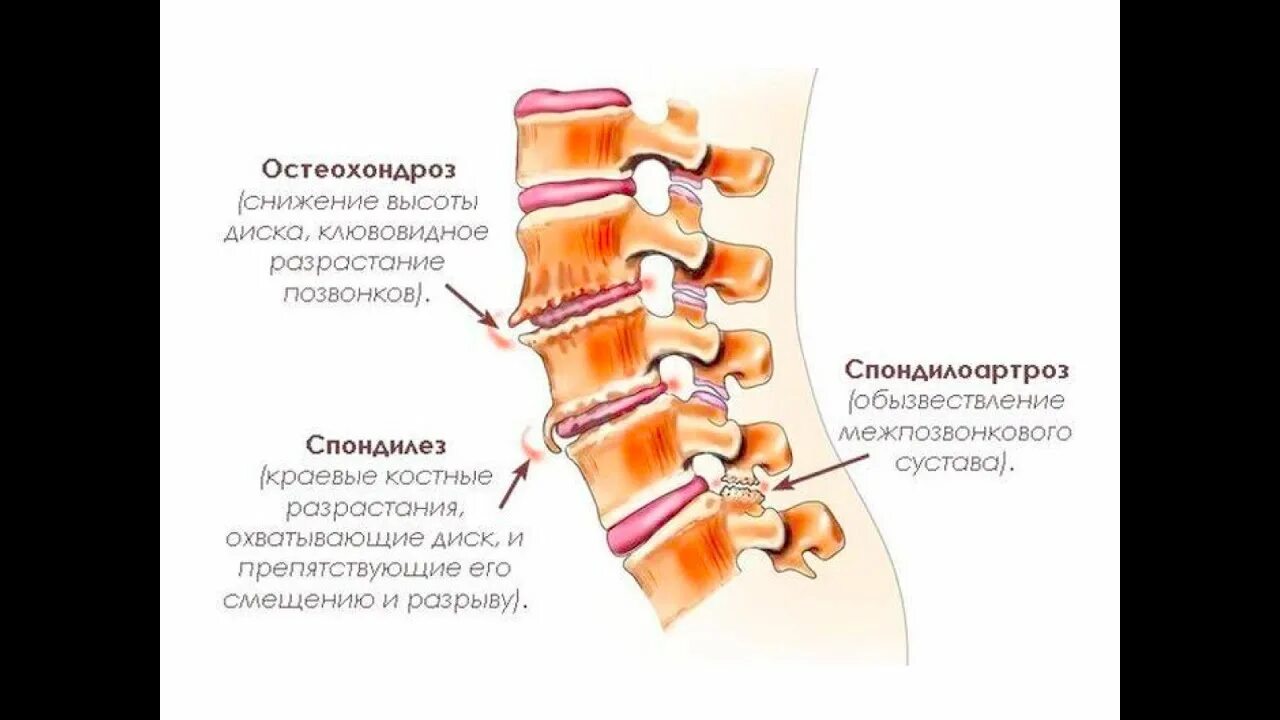 Деформирующий спондилез l1-l3. Полисегментарный спондилез. Спондилёз поясничного отдела позвоночника что это такое. Краевые остеофиты шейного отдела позвоночника.