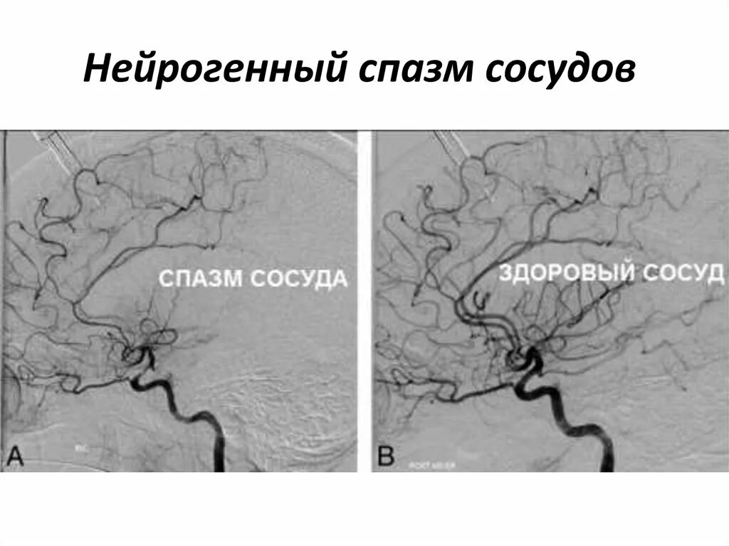 Ангиоспазм периферических сосудов. Спазмах периферических сосудов это. Почему спазм сосудов