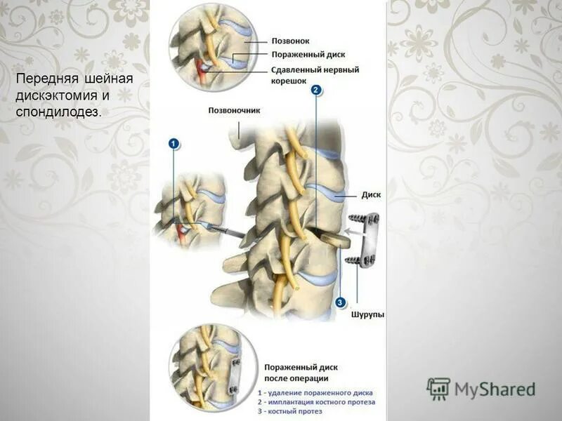 Операция грыжи шейного отдела позвоночника отзывы. Кейдж для позвоночника поясничного отдела. Спондилодез поясничного. Спондилодез Кейджем шейного отдела. Передний спондилодез Кейджем с5-с6.