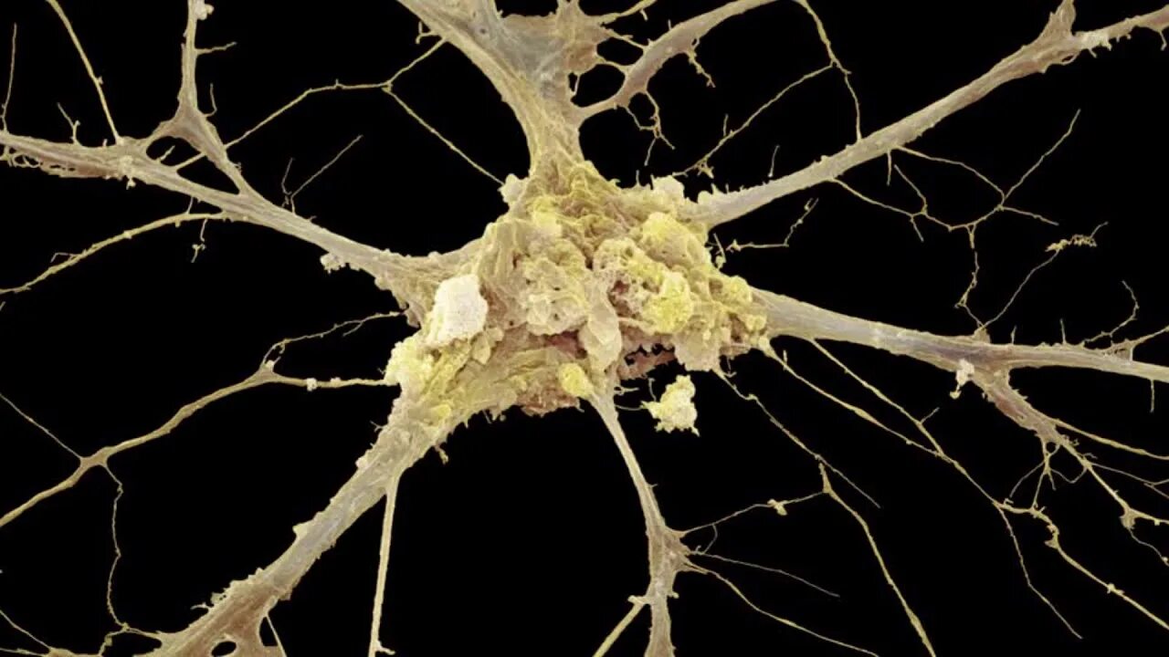 Разрушенная нервная система. Нервная ткань под микроскопом. Нейроны мозга. Клетки нервной ткани под микроскопом. Нервные клетки под микроскопом.