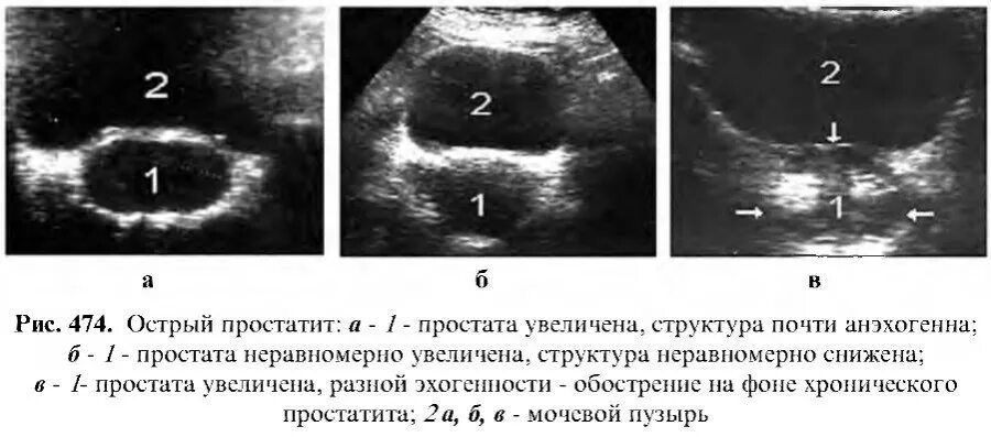 Сколько длится простата. УЗИ признаки острого простатита. УЗИ предстательной железы при простатите. УЗИ симптомы аденомы предстательной железы. Кальцинат предстательной железы УЗИ.