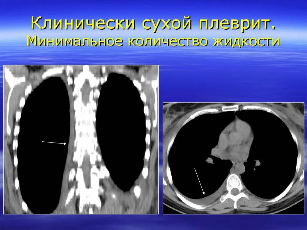 Туберкулезная эмпиема рентген. Эмпиема легкого